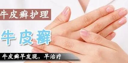 夏季护理牛皮癣都有哪些方法【惠州广肤皮肤病专科】
