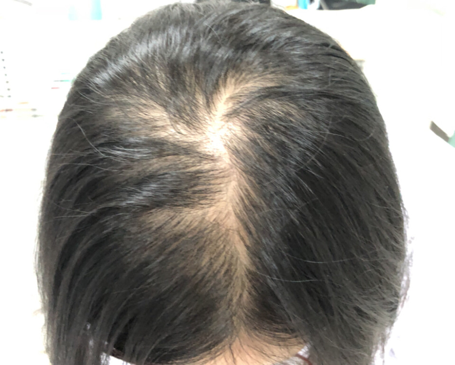 脱发有哪些护理方法【惠州广肤治疗脱发专科医院】