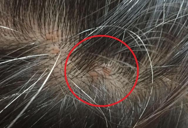 脂溢性皮炎的早期症状【惠城广肤皮肤病专科好不好】