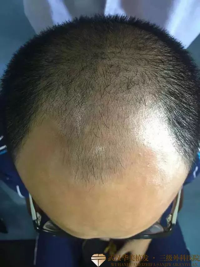 惠州看脱发医院哪家比较好,脱发预防方法有哪些【惠州广肤皮肤门诊部正不正规】
