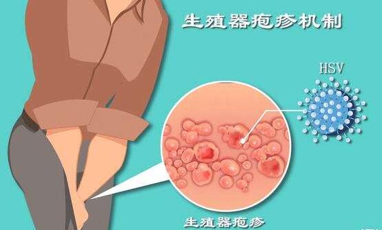 早期生殖器疱疹如何治疗【惠州广肤皮肤病专科】性病医院