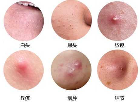 脸上痘痘很严重怎么办【惠州广肤皮肤病专科】